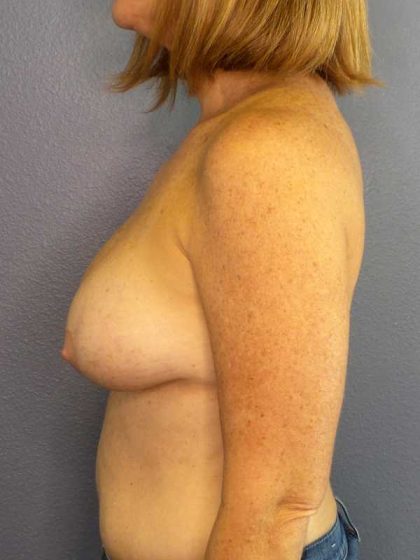 Augmentation Mastopexy Revision Before & After Patient #4650