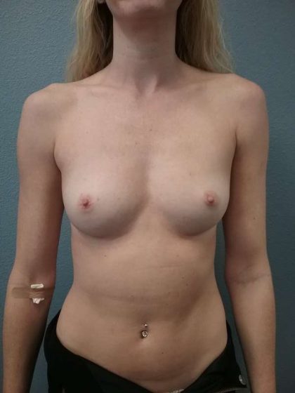 Breast Augmentation Before & After Patient #6558
