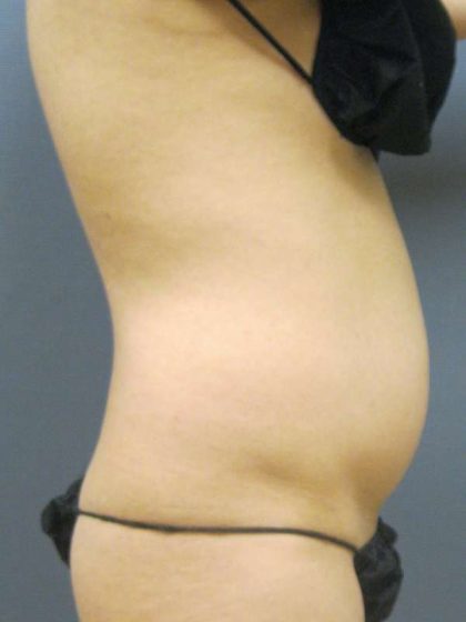 Liposuction Female Before & After Patient #7862