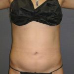 Liposuction Female Before & After Patient #7862