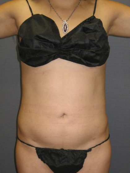 Liposuction Female Before & After Patient #7862