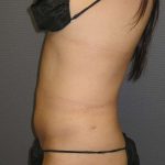 Liposuction Female Before & After Patient #7862