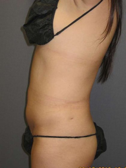 Liposuction Female Before & After Patient #7862