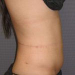 Liposuction Female Before & After Patient #7862