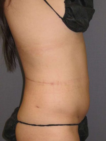 Liposuction Female Before & After Patient #7862