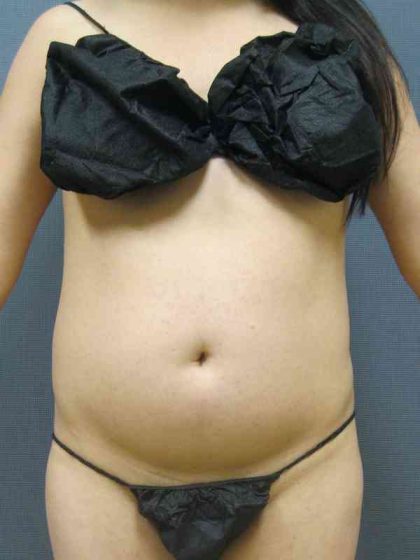 Liposuction Female Before & After Patient #7862