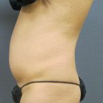 Liposuction Female Before & After Patient #7862