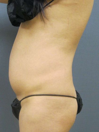 Liposuction Female Before & After Patient #7862