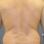 Male Liposuction Before & After Patient #8167