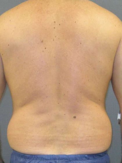 Male Liposuction Before & After Patient #8167
