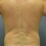 Male Liposuction Before & After Patient #8167