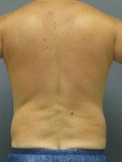 Male Liposuction Before & After Patient #8167