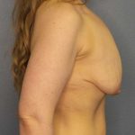 Breast Lift with Implant (Augmentation Mastopexy) Before & After Patient #4098