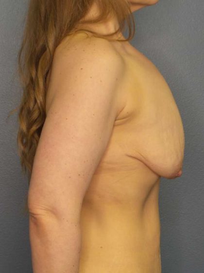 Breast Lift with Implant (Augmentation Mastopexy) Before & After Patient #4098