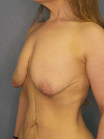 Breast Lift with Implant (Augmentation Mastopexy) Before & After Patient #4098