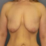 Breast Lift with Implant (Augmentation Mastopexy) Before & After Patient #4098