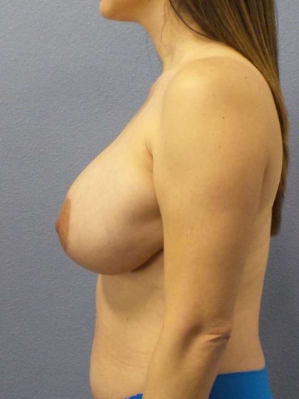 Breast Lift with Implant (Augmentation Mastopexy) Before & After Patient #4303