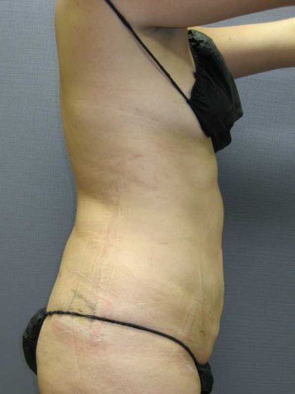 Liposuction Female Before & After Patient #7850