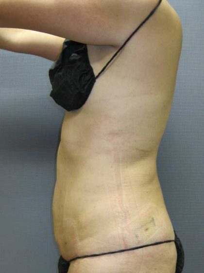 Liposuction Female Before & After Patient #7850