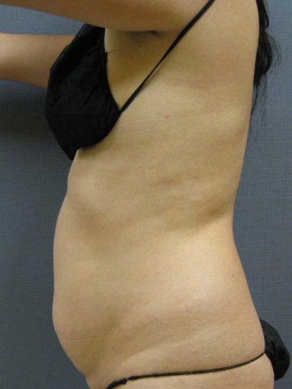 Liposuction Female Before & After Patient #7850