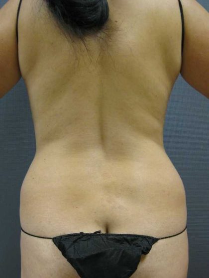 Liposuction Female Before & After Patient #7850