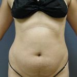 Liposuction Female Before & After Patient #7850