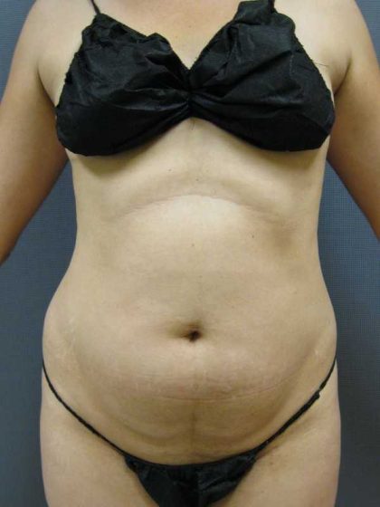 Liposuction Female Before & After Patient #7850