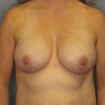 Breast Augmentation Before & After Patient #6236