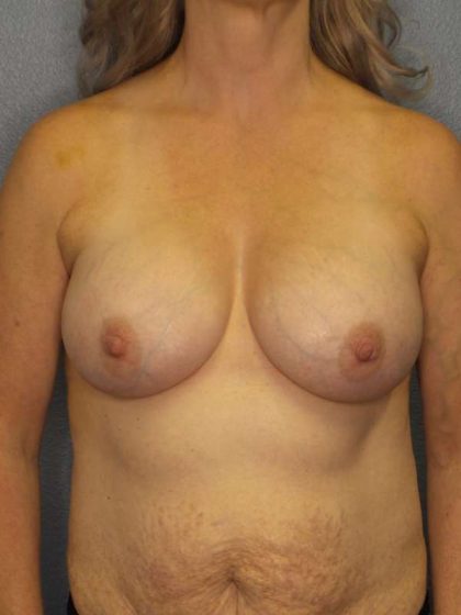 Breast Augmentation Before & After Patient #6236
