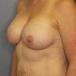 Breast Augmentation Before & After Patient #6236