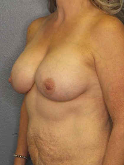 Breast Augmentation Before & After Patient #6236