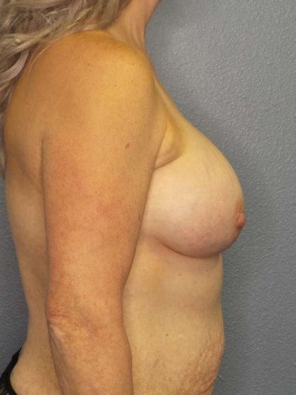 Breast Augmentation Before & After Patient #6236