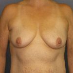 Breast Augmentation Before & After Patient #6236