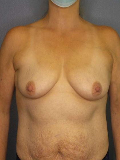 Breast Augmentation Before & After Patient #6236