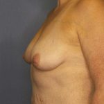 Breast Augmentation Before & After Patient #6236