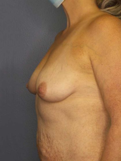 Breast Augmentation Before & After Patient #6236