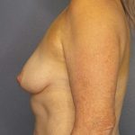 Breast Augmentation Before & After Patient #6236