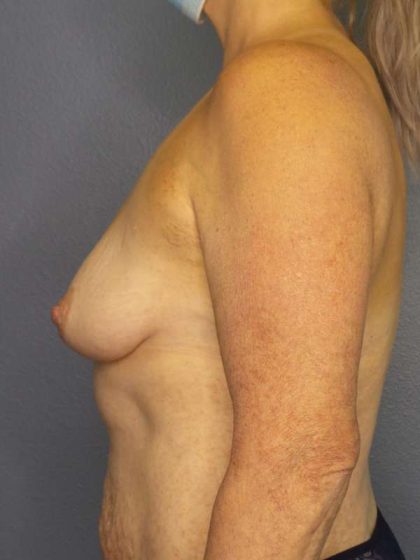 Breast Augmentation Before & After Patient #6236