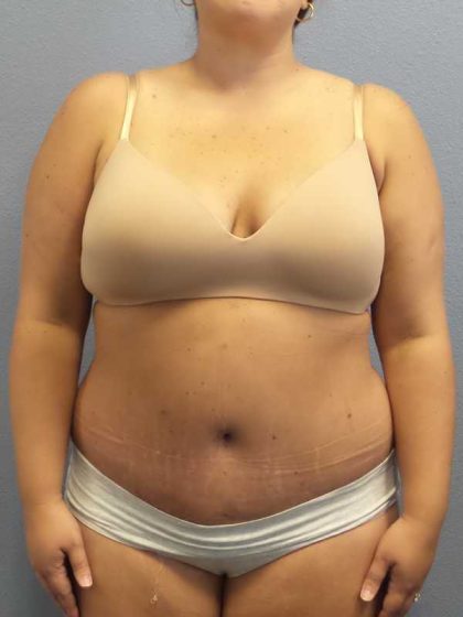 High BMI (Larger Patients) Surgery Before & After Patient #10274