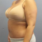 High BMI (Larger Patients) Surgery Before & After Patient #10274