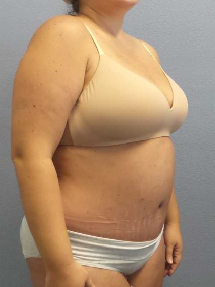 High BMI (Larger Patients) Surgery Before & After Patient #10274