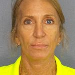 Facelift Before & After Patient #7576