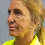 Facelift Before & After Patient #7576