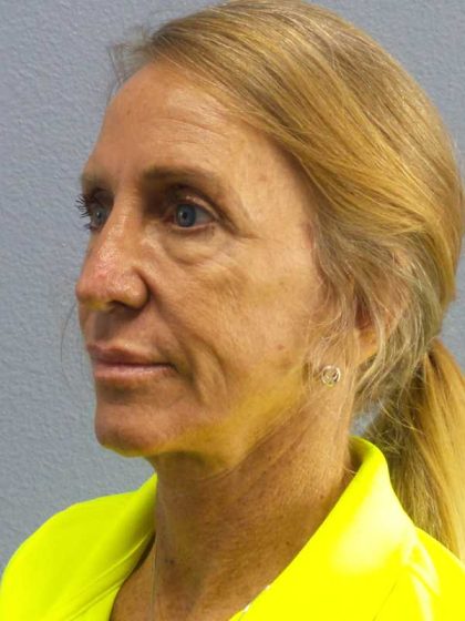 Facelift Before & After Patient #7576