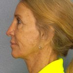 Facelift Before & After Patient #7576