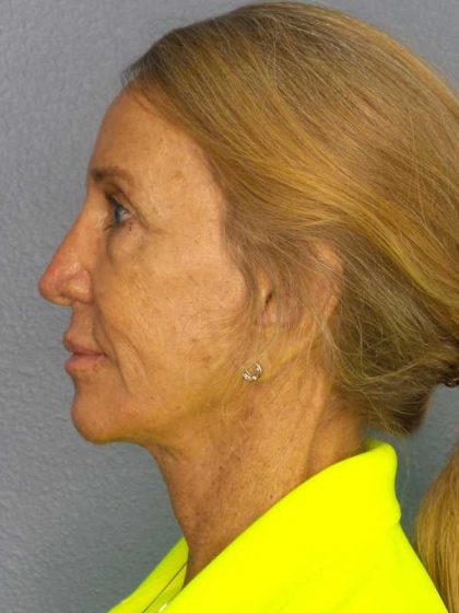 Facelift Before & After Patient #7576
