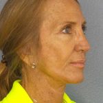 Rhinoplasty Before & After Patient #11062