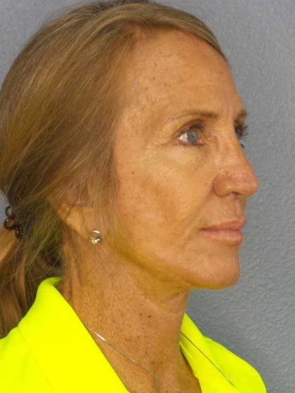 Facelift Before & After Patient #7576