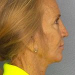 Rhinoplasty Before & After Patient #11062