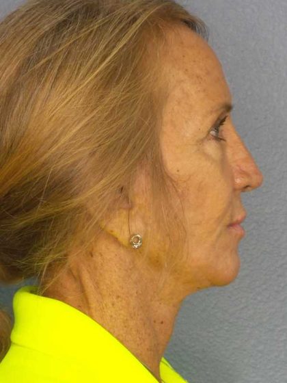 Rhinoplasty Before & After Patient #11062
